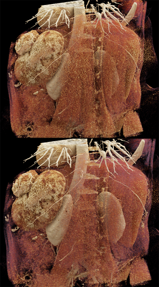 MDCT of the Spleen