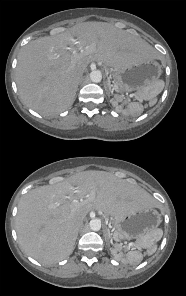 Interrupted IVC with Polysplenia