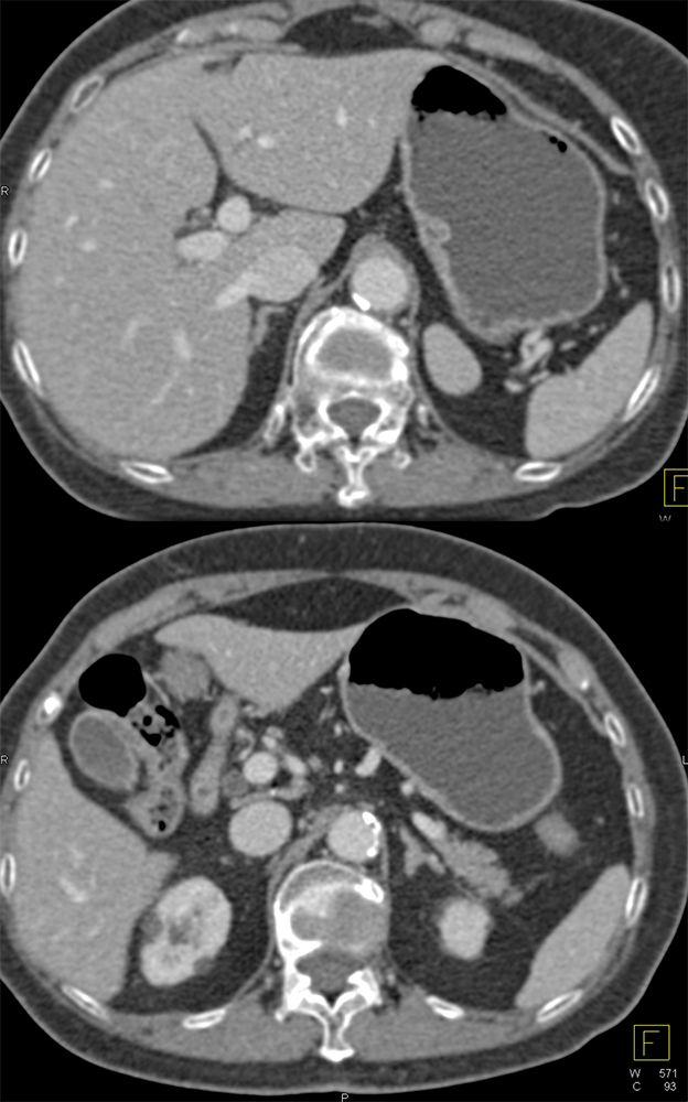 Accessory Spleen Simulates an Adrenal Mass