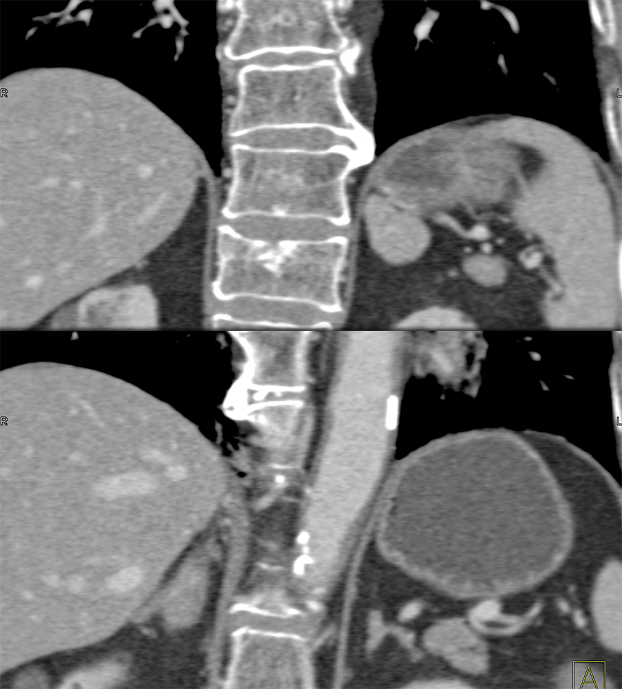 MDCT of the Spleen