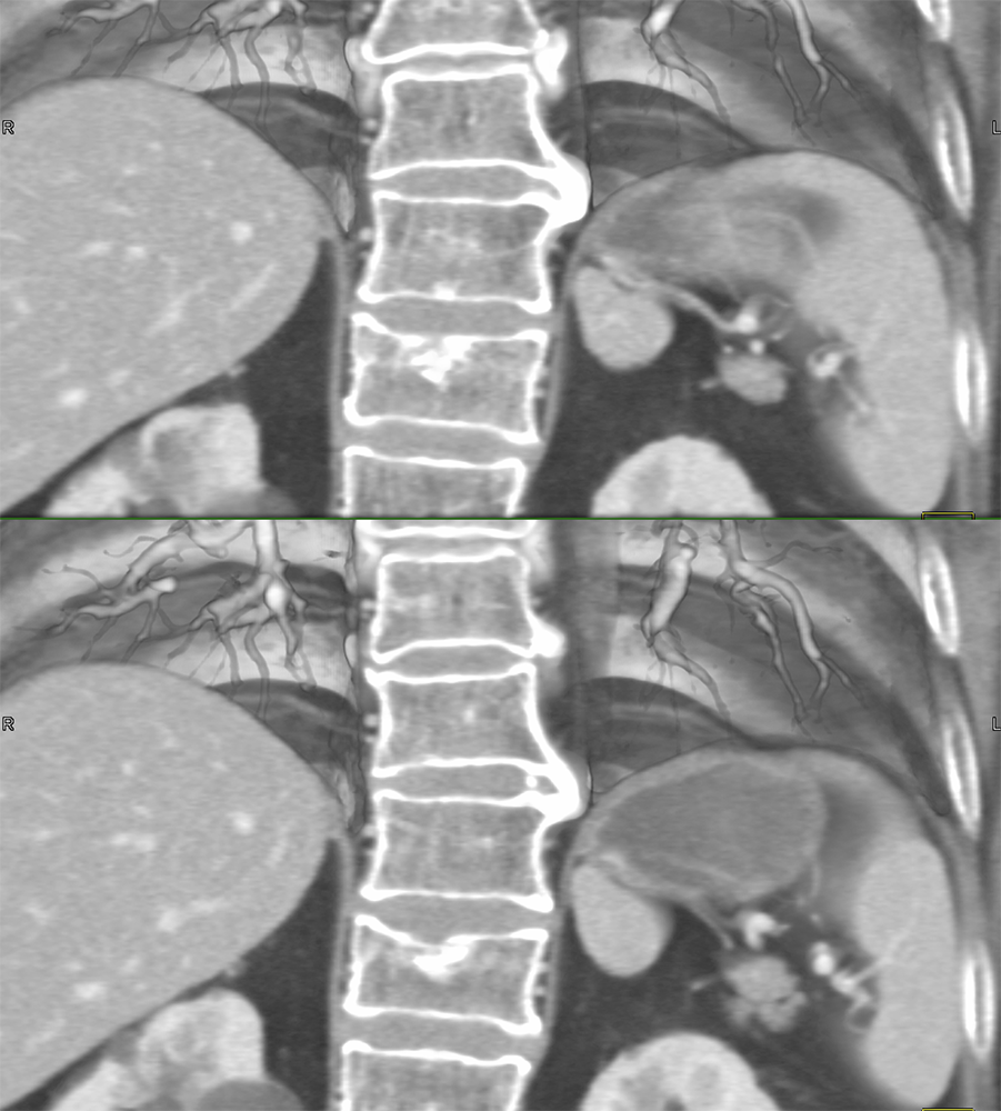 MDCT of the Spleen