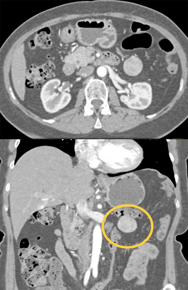 MDCT of the Spleen