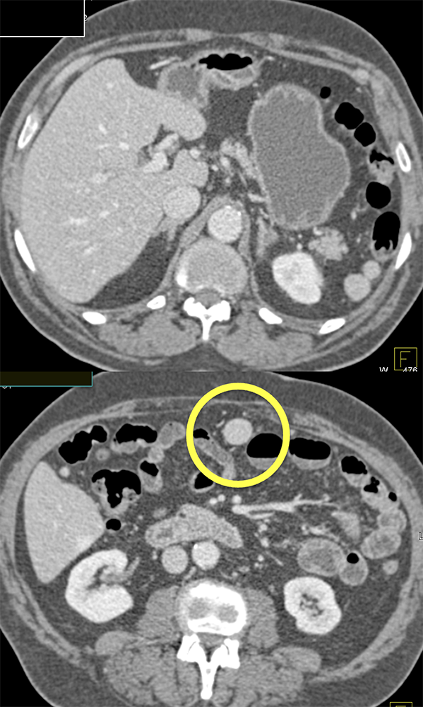 MDCT of the Spleen