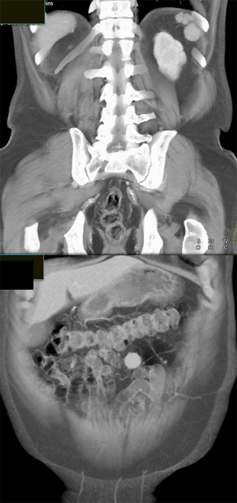 MDCT of the Spleen