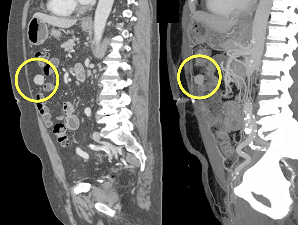 MDCT of the Spleen