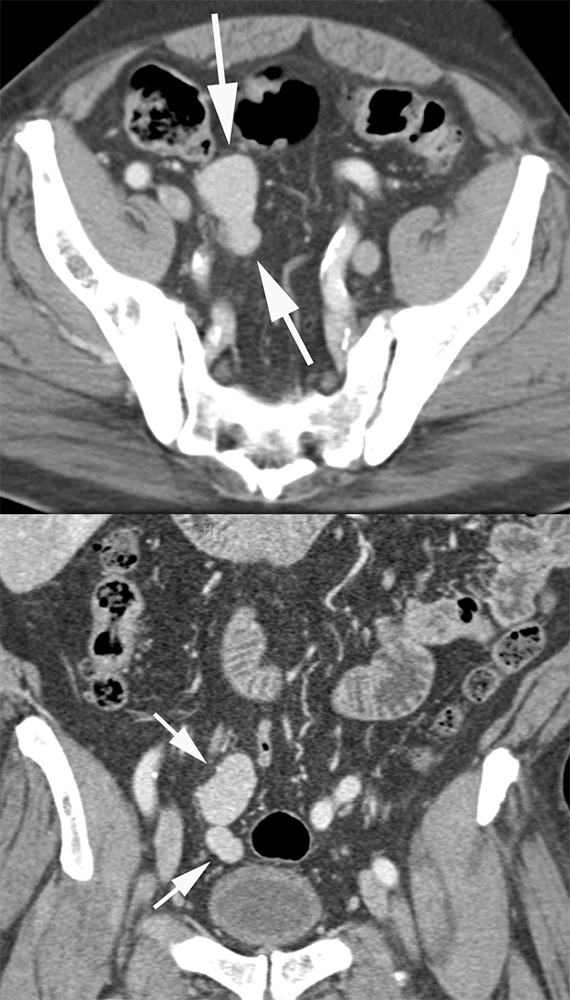 Splenosis Pelvis