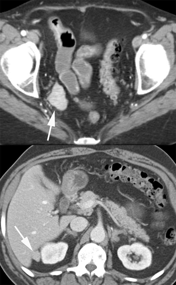 MDCT of the Spleen