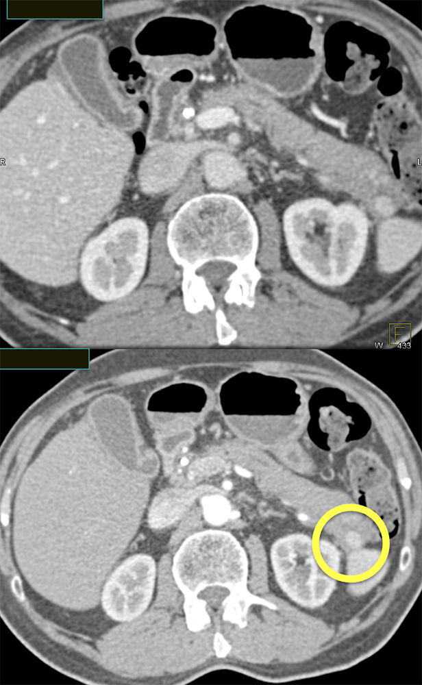 Islet Cell Tumor vs Splenic Tissue