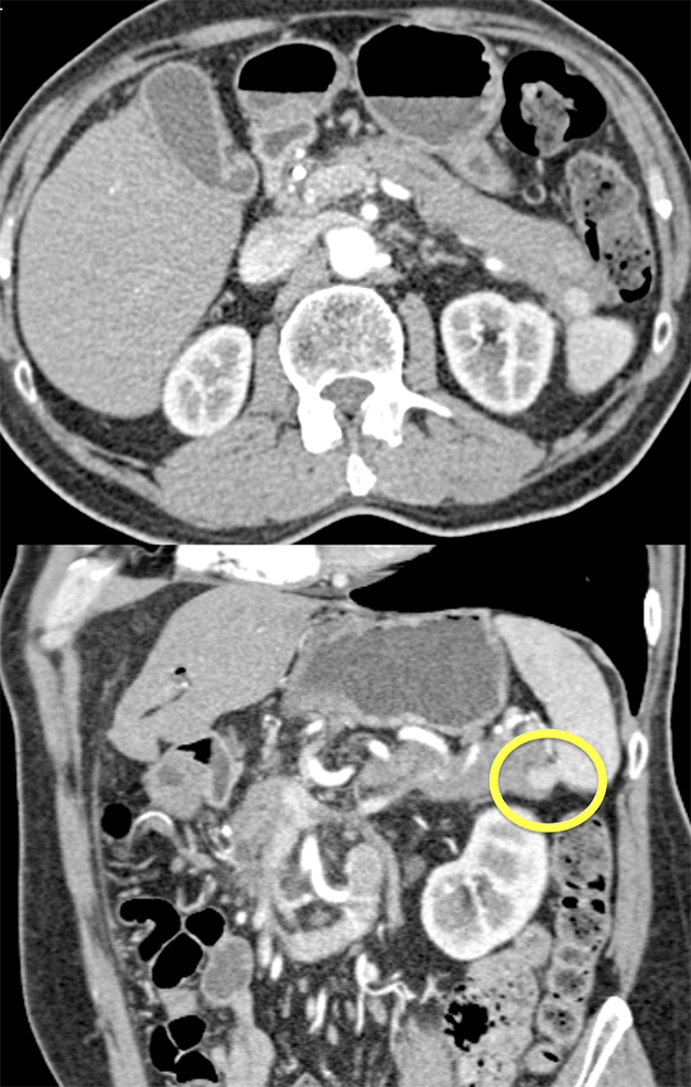 MDCT of the Spleen