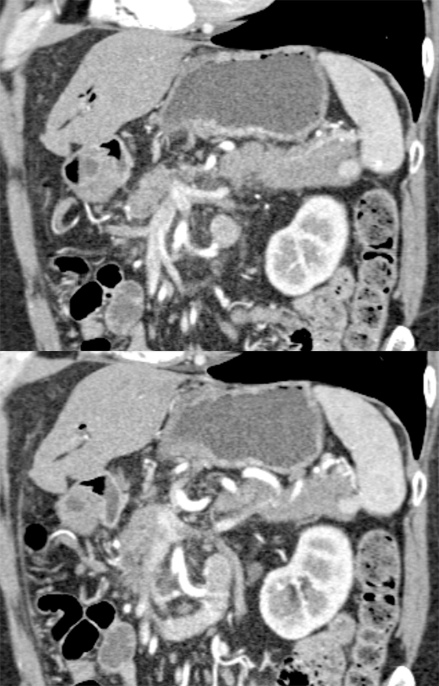 MDCT of the Spleen