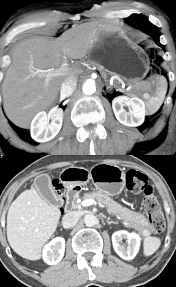 MDCT of the Spleen