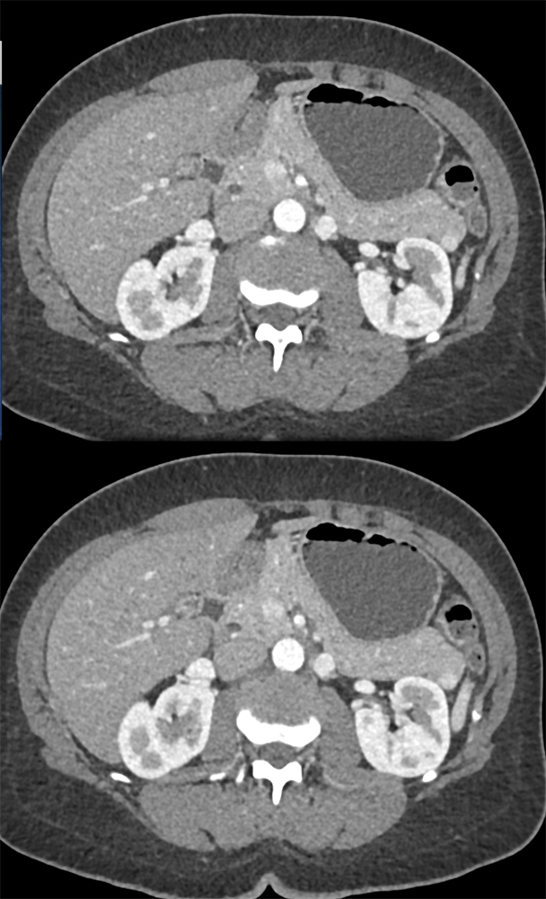 Accessory Spleen in a Potential Renal Donor