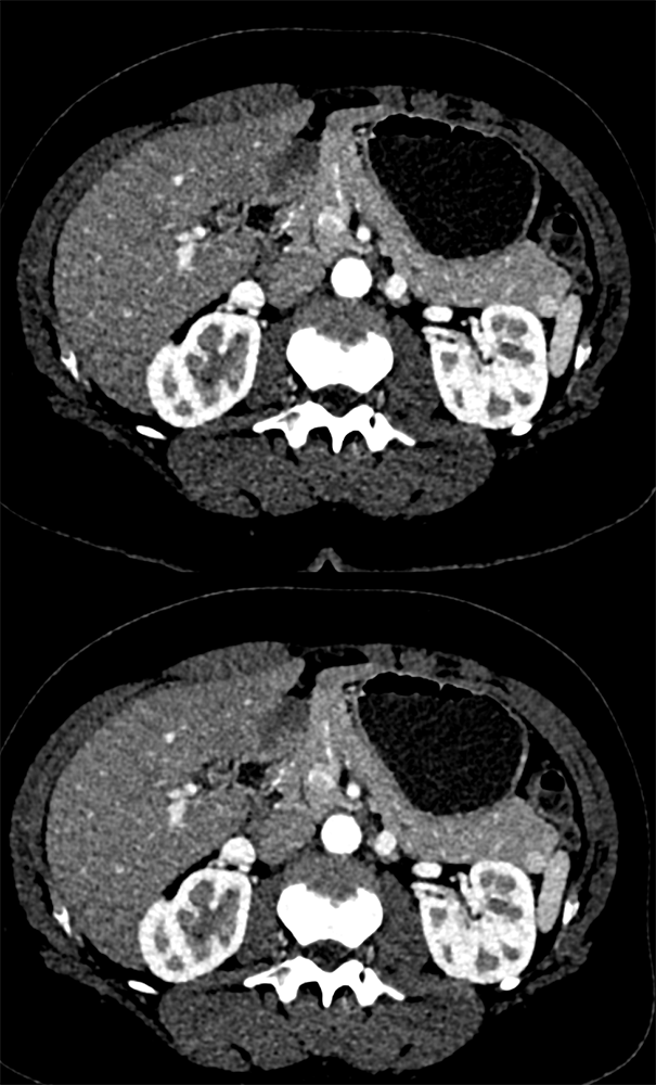 MDCT of the Spleen