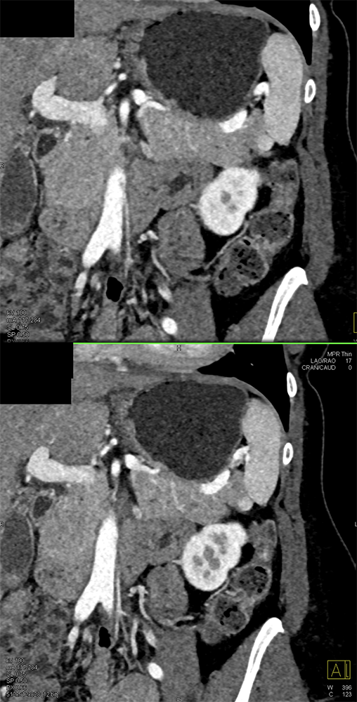 MDCT of the Spleen