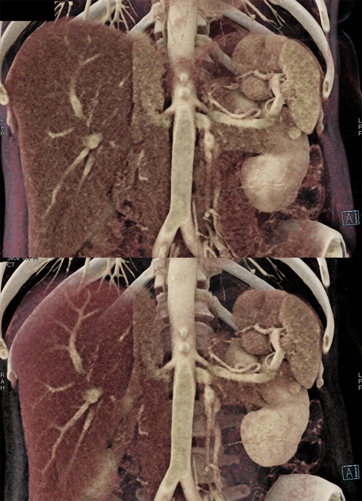 MDCT of the Spleen