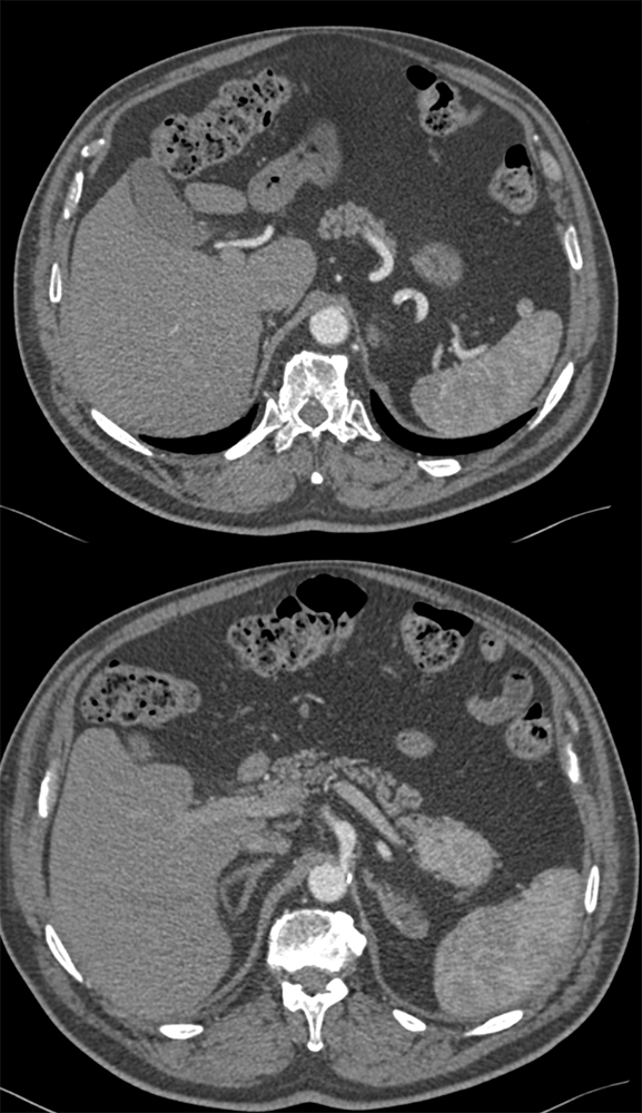 Accessory Spleen Involves TOP (5 cm)