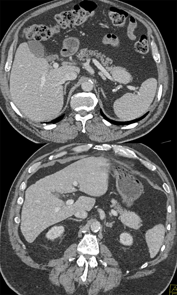 MDCT of the Spleen