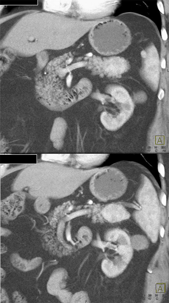 MDCT of the Spleen