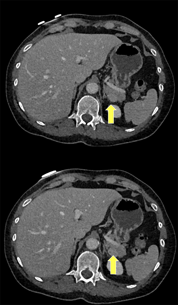 Accessory Spleen