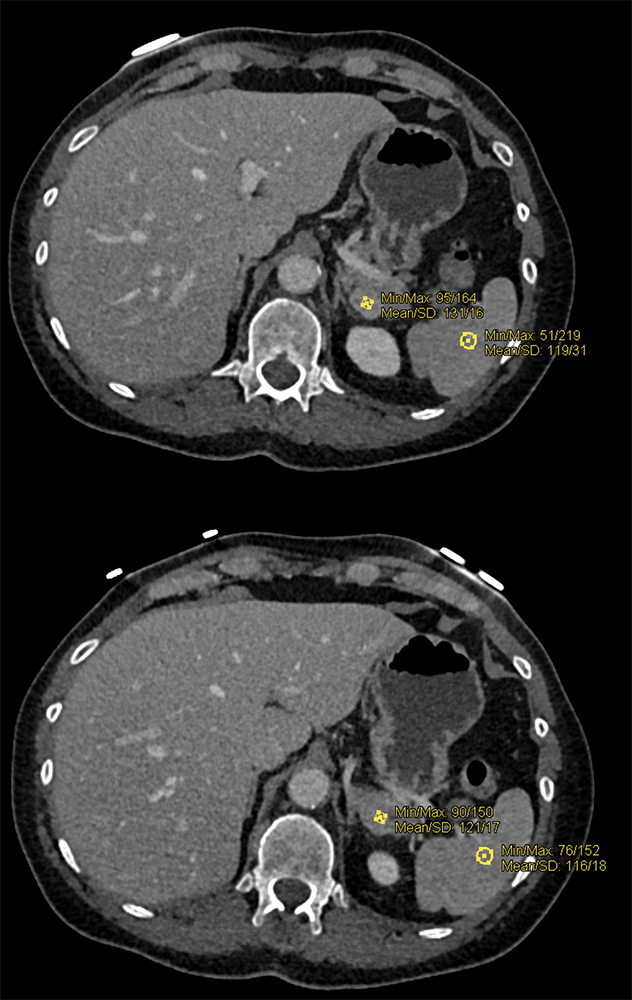 MDCT of the Spleen