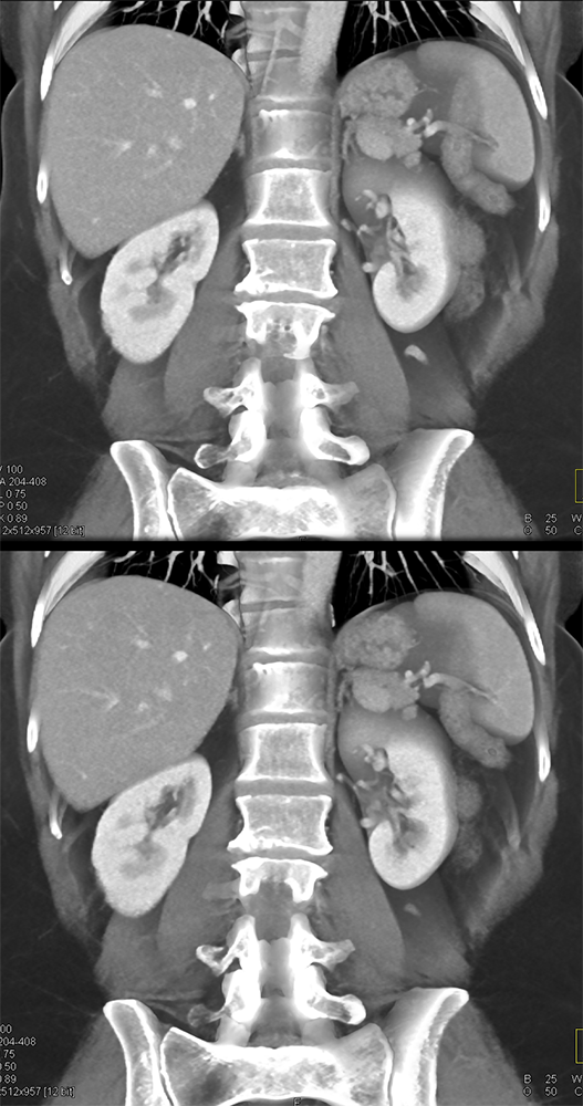 MDCT of the Spleen