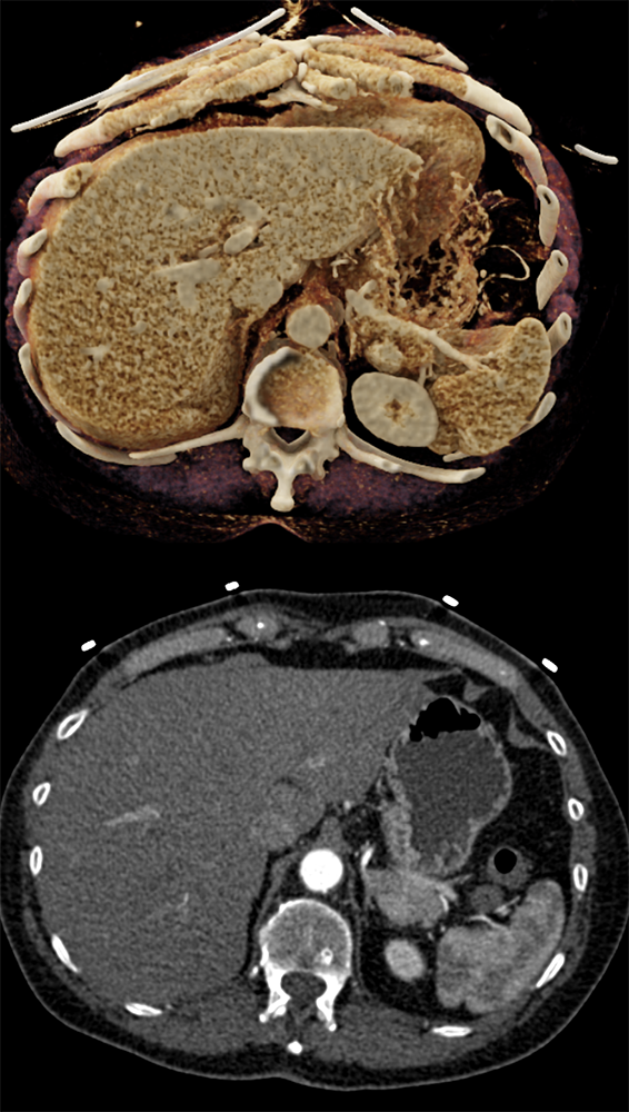 MDCT of the Spleen