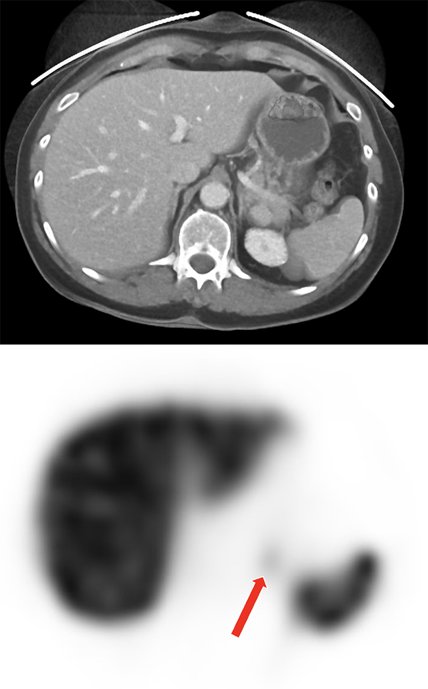 MDCT of the Spleen