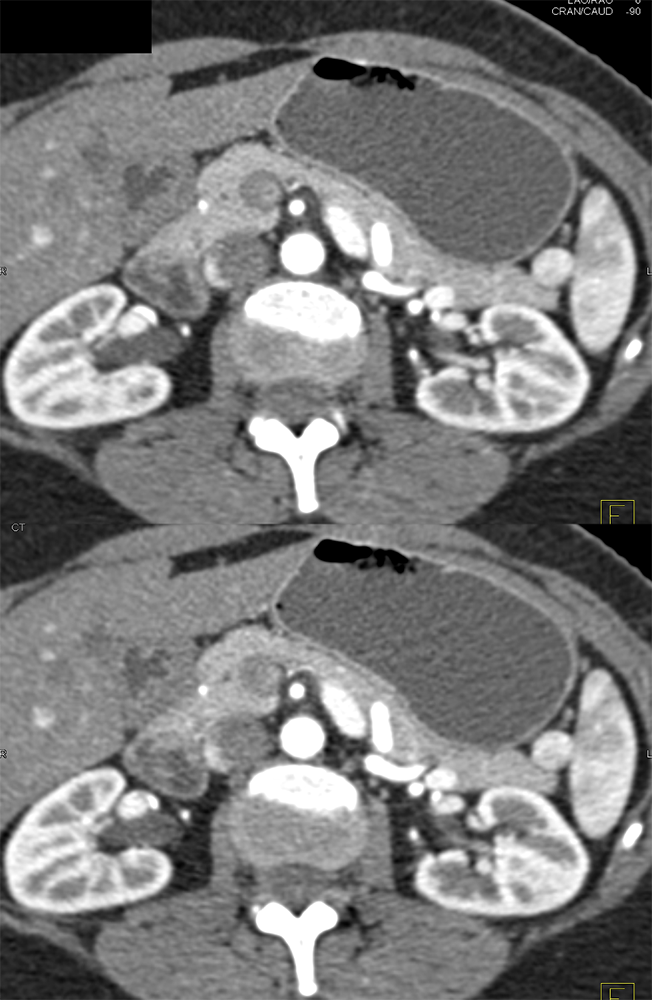 Accessory Spleen