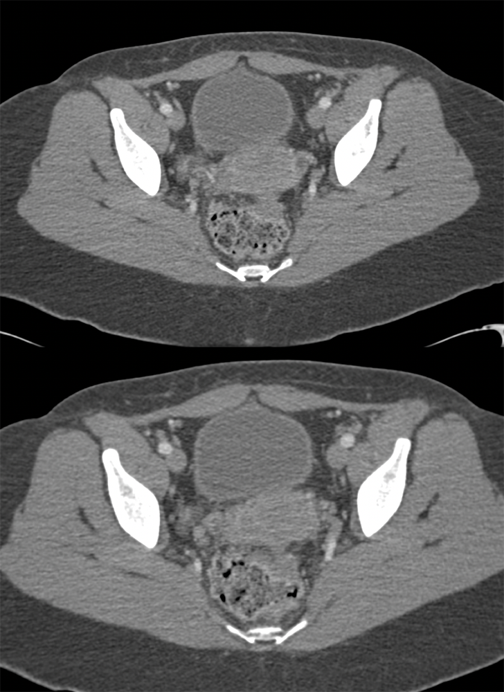 Endometriosis on Rectum