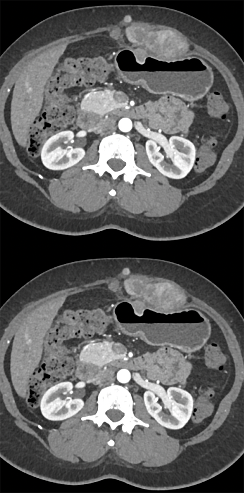 Endometriosis