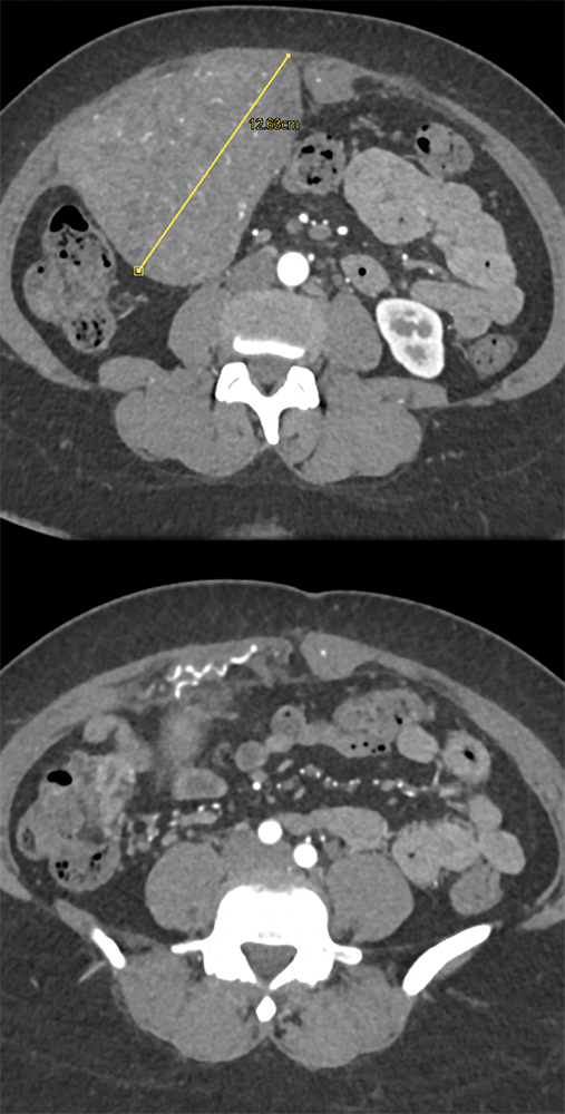 Endometriosis