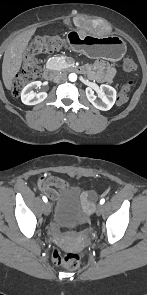 Endometriosis