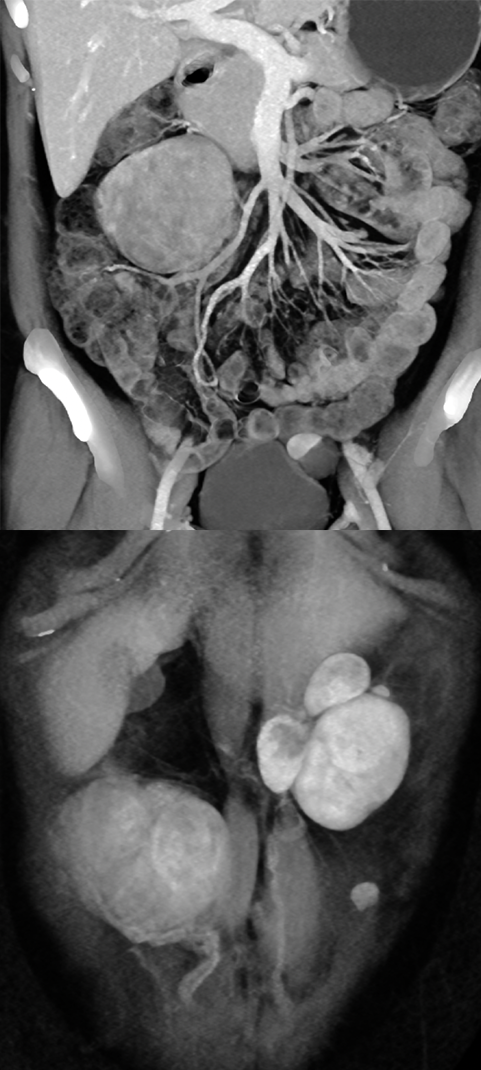 Endometriosis