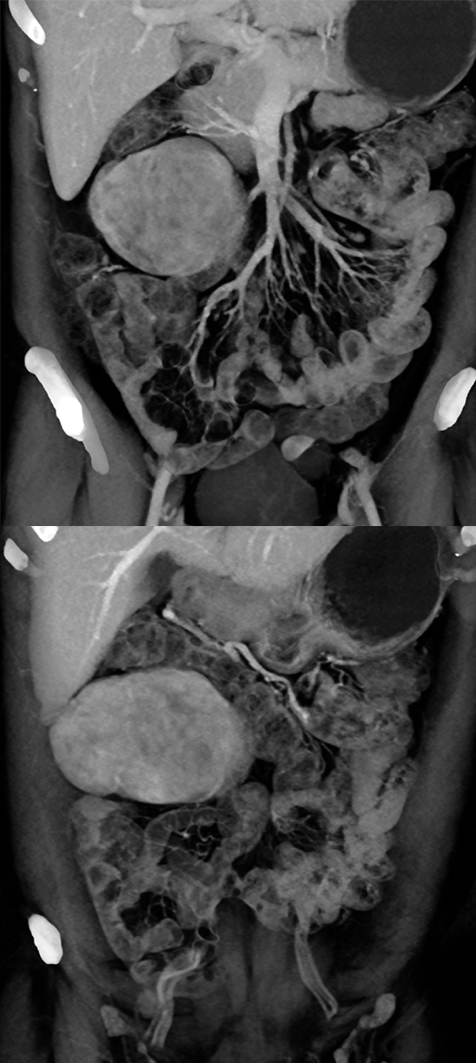 Endometriosis