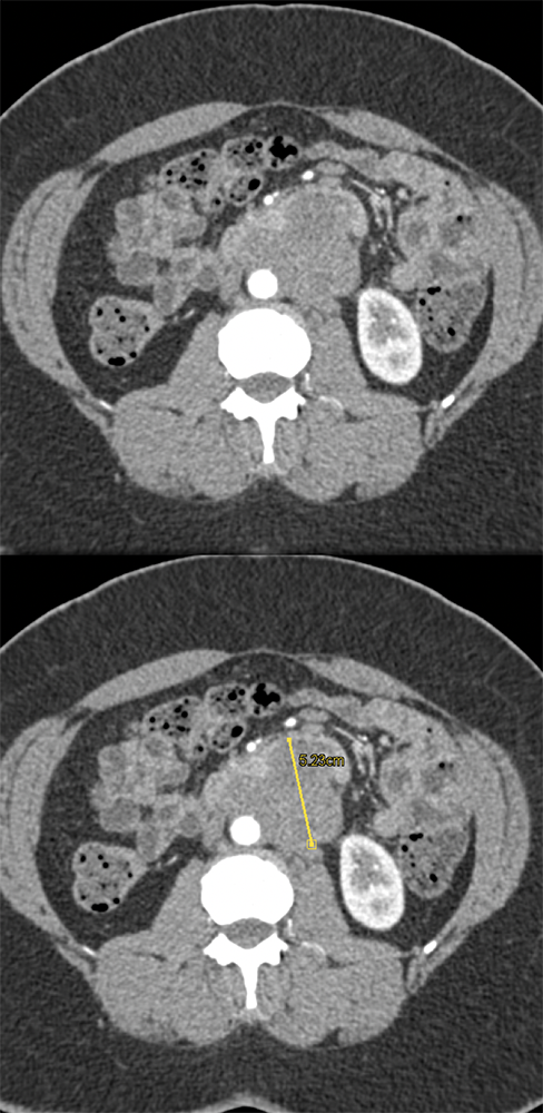 Endometriosis