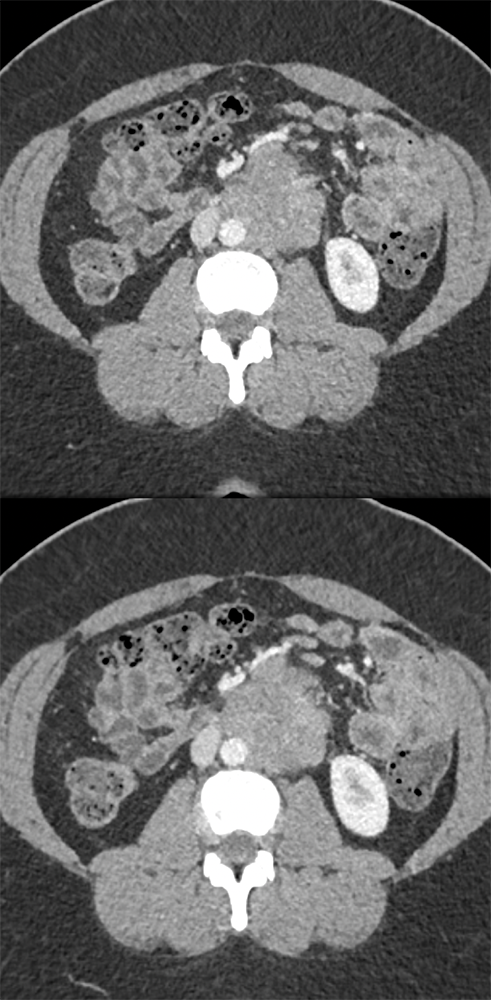 Endometriosis