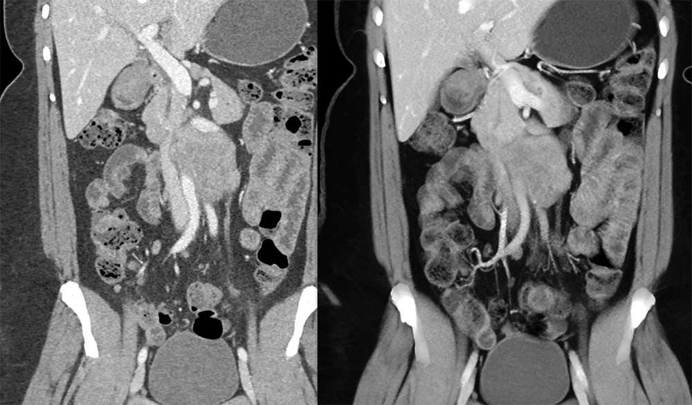 Endometriosis