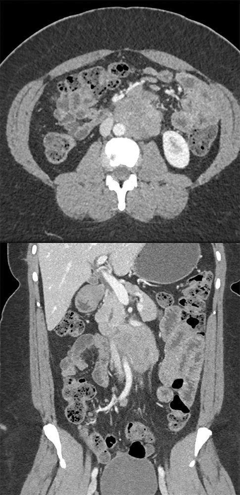 Endometriosis