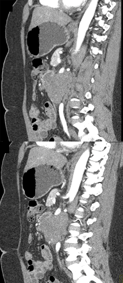 Endometriosis