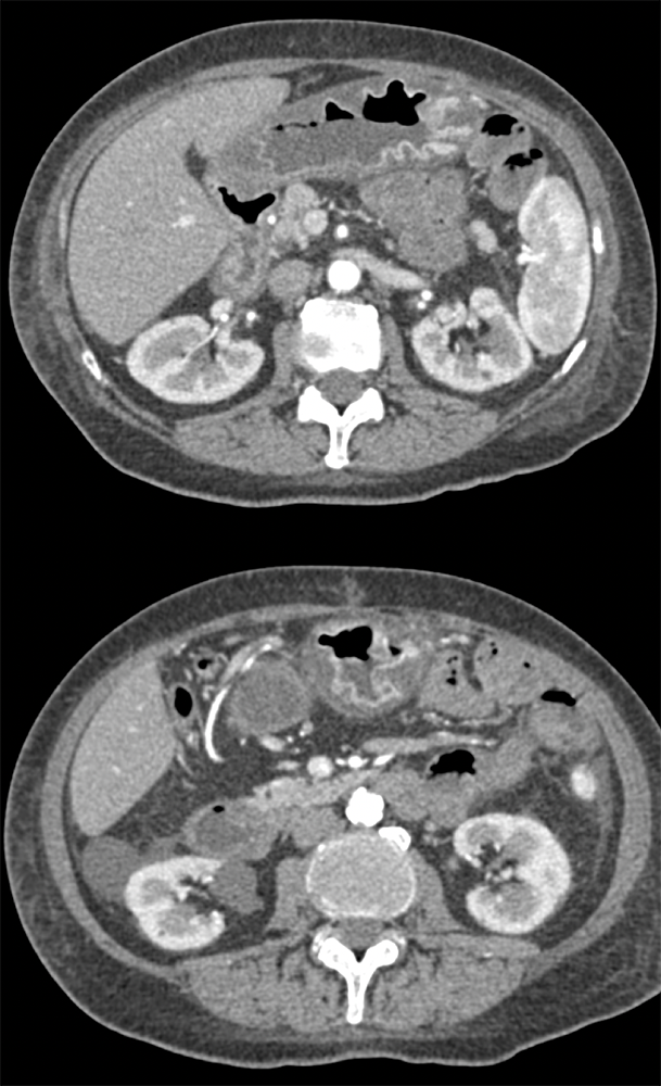 Endometriosis Involves Distal Bowel