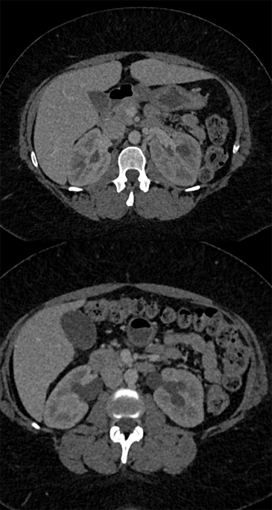 Endometriosis