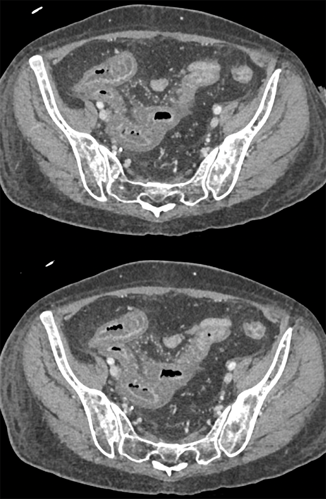 Endometriosis Involves Distal Bowel