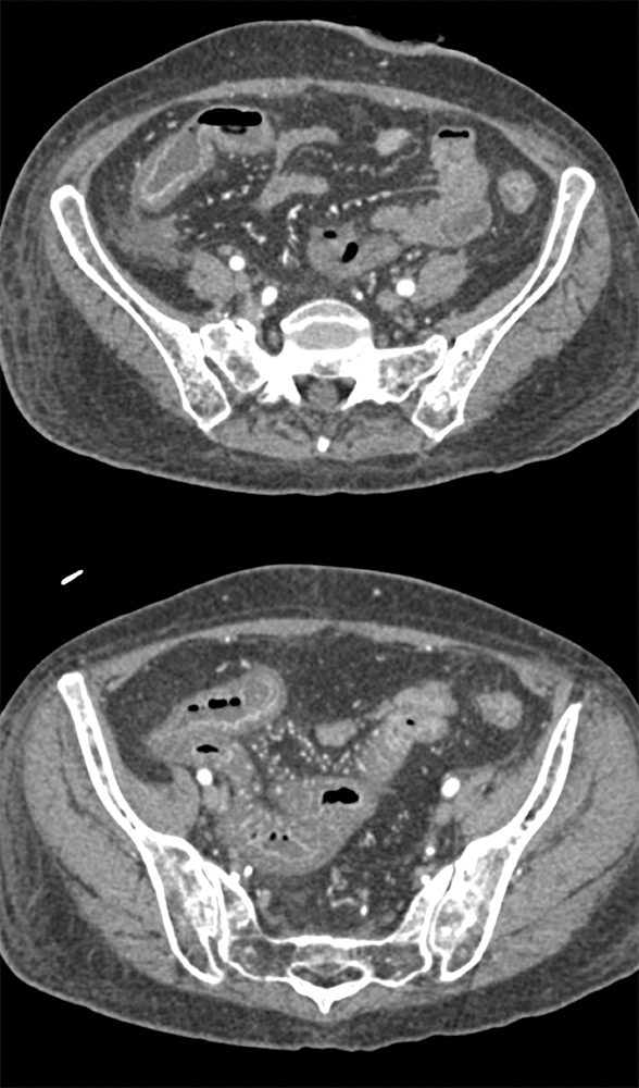 Endometriosis Involves Distal Bowel