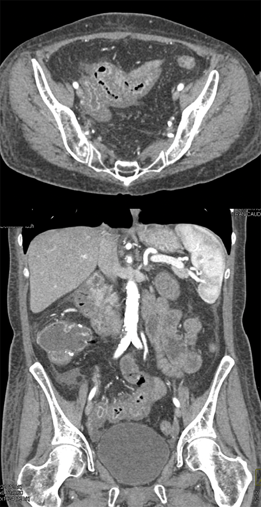 Endometriosis Involves Distal Bowel