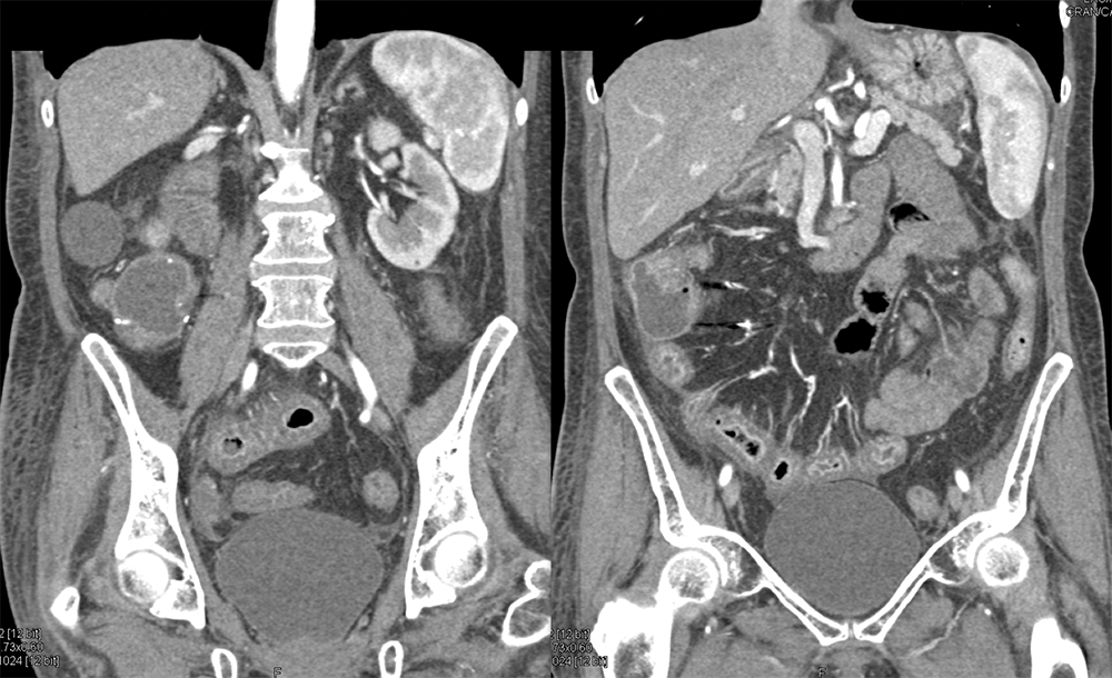 Endometriosis Involves Distal Bowel