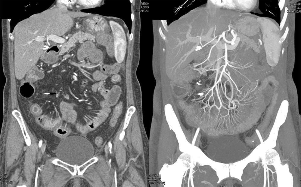 Endometriosis Involves Distal Bowel