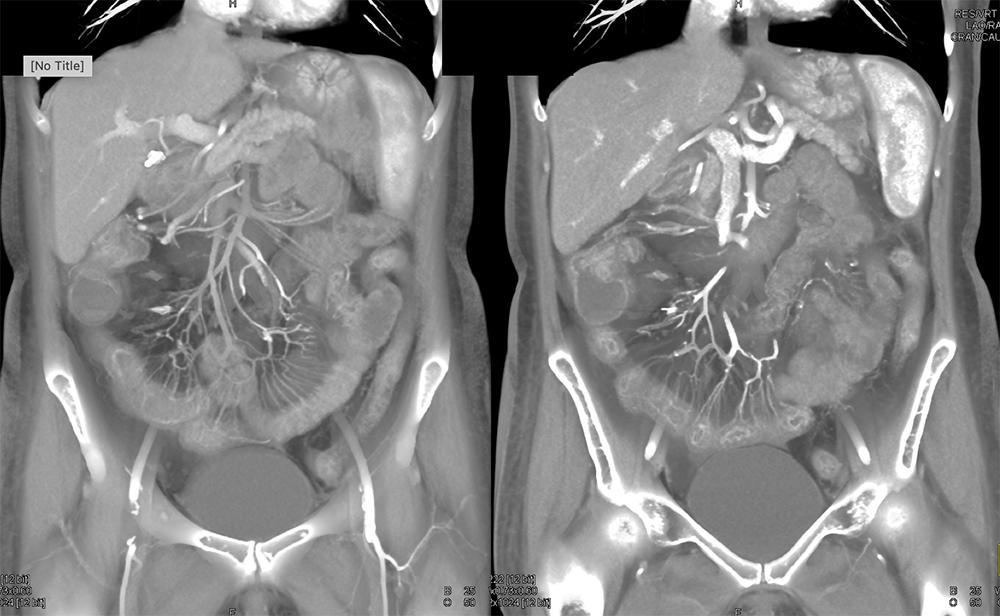 Endometriosis Involves Distal Bowel