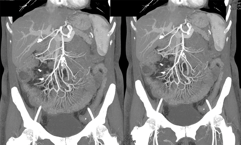 Endometriosis Involves Distal Bowel