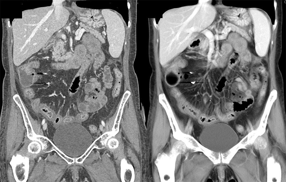 Endometriosis Involves Distal Bowel