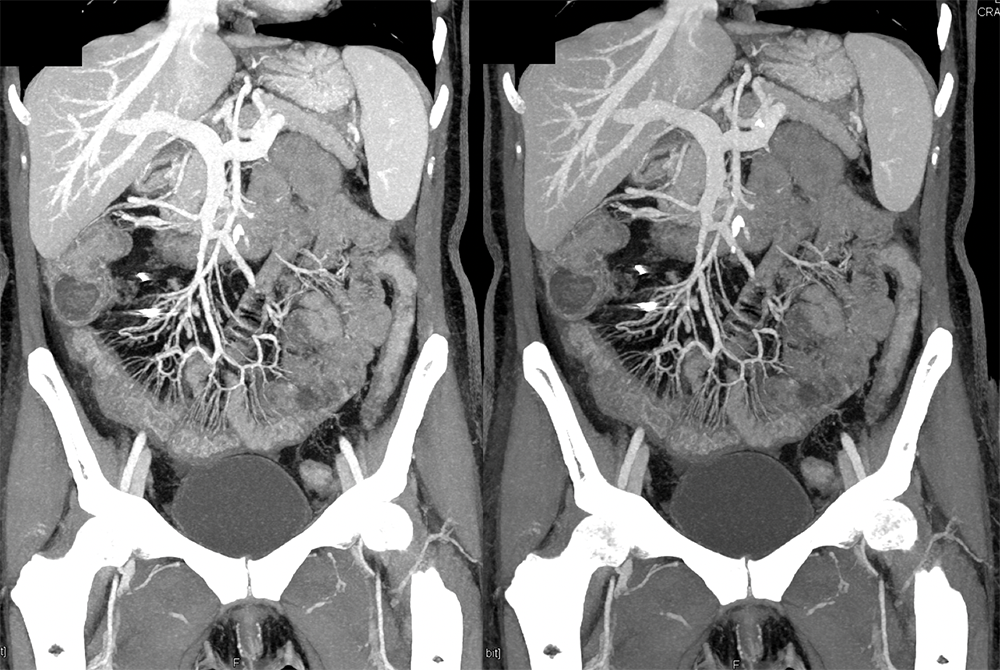 Endometriosis Involves Distal Bowel